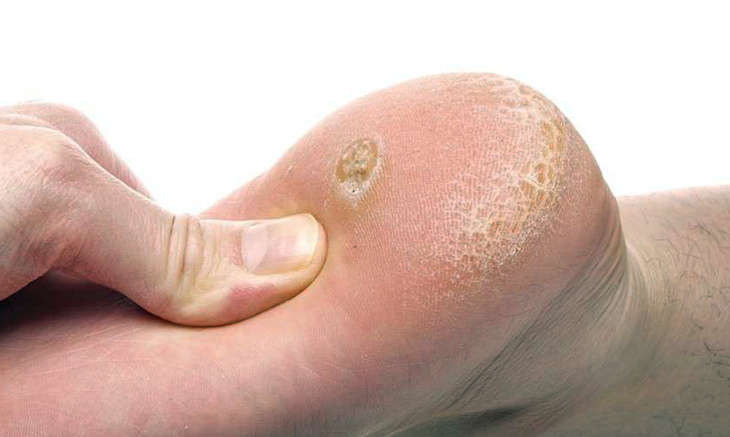 Podologia Colasanto - Trattamento verruche