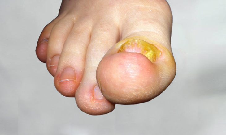 Podologia Colasanto Onicogrifosi ispessimento ungueale