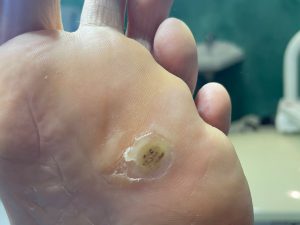 Verruche ai piedi: come riconoscerle